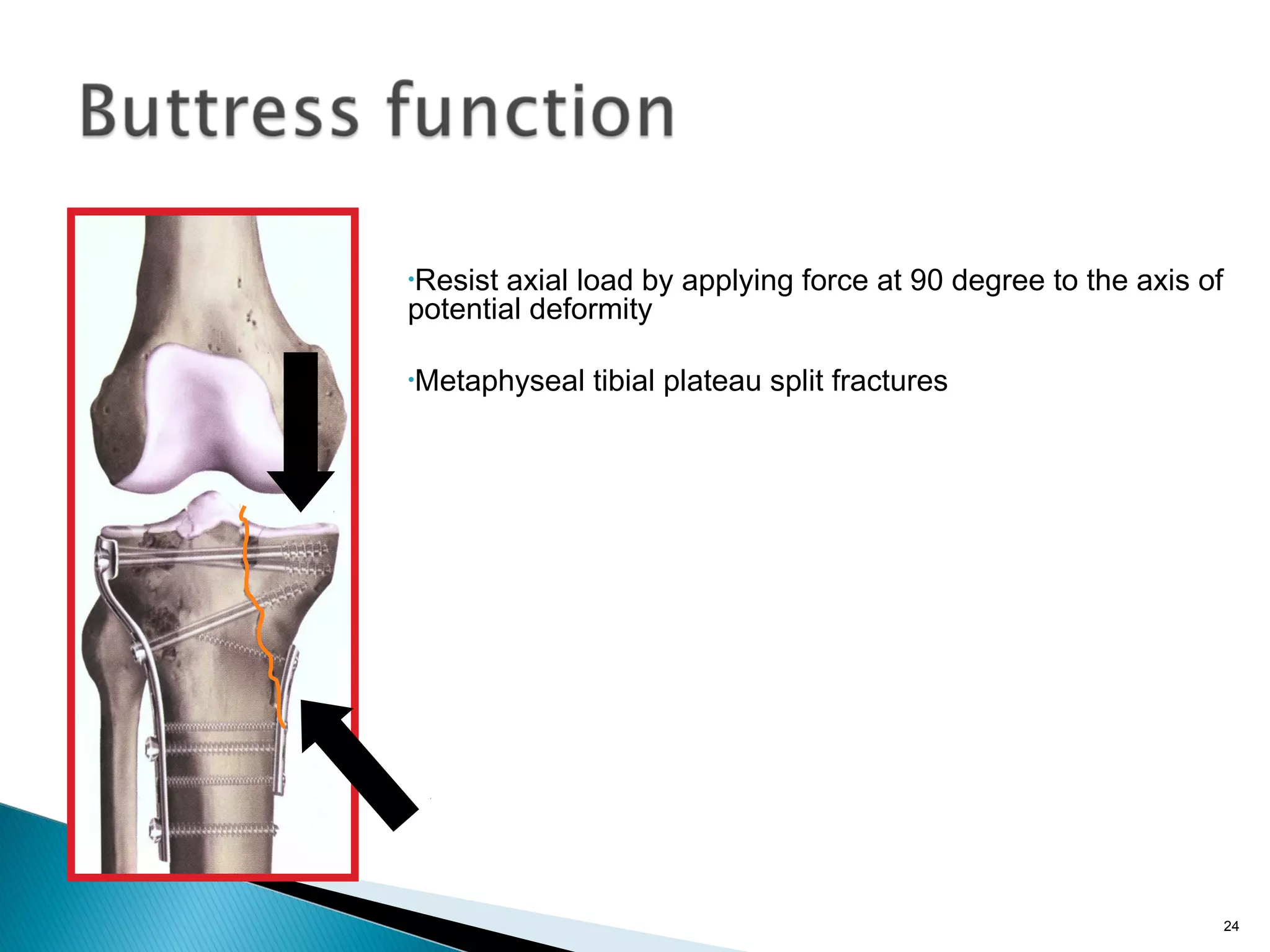 •Resist axial load by applying force at 90 degree to the axis of
potential deformity
•Metaphyseal tibial plateau split fractures
24
 
