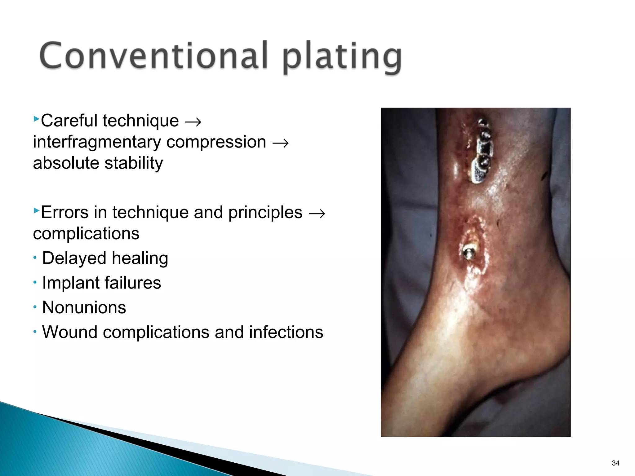 Careful technique →
interfragmentary compression →
absolute stability
Errors in technique and principles →
complications
• Delayed healing
• Implant failures
• Nonunions
• Wound complications and infections
34
 
