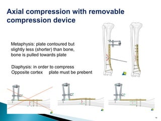 14
Axial compression with removable
compression device
Metaphysis: plate contoured but
slightly less (shorter) than bone,
bone is pulled towards plate
Diaphysis: in order to compress
Opposite cortex plate must be prebent
 