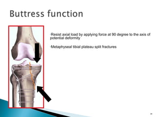 •Resist axial load by applying force at 90 degree to the axis of
potential deformity
•Metaphyseal tibial plateau split fractures
24
 