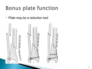  Plate may be a reduction tool
30
 