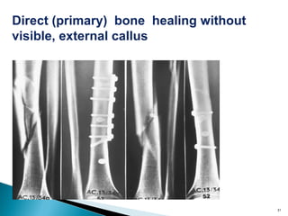 31
Direct (primary) bone healing without
visible, external callus
 