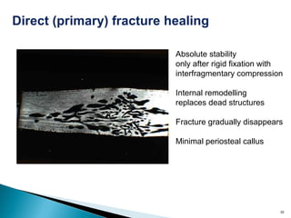 32
Absolute stability
only after rigid fixation with
interfragmentary compression
Internal remodelling
replaces dead structures
Fracture gradually disappears
Minimal periosteal callus
Direct (primary) fracture healing
 