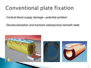 • Cortical blood supply damage—potential problem
• Devascularization and transient osteoporosis beneath plate
37
 