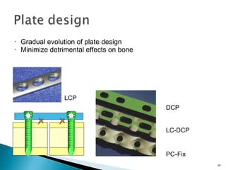 • Gradual evolution of plate design
• Minimize detrimental effects on bone
40
DCP
LC-DCP
PC-Fix
LCP
 