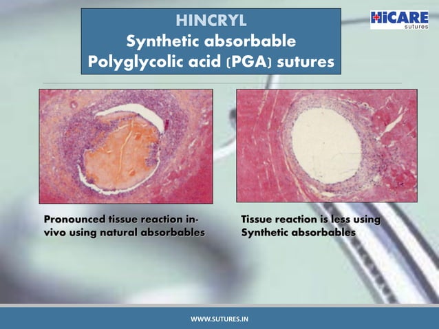 Types of Absorbable Sutures