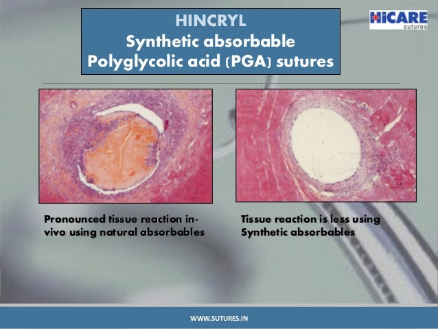 Types of Absorbable Sutures