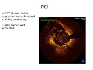 PCI
● OCT showed better
apposition and sub intimal
staining decreasing.

● Side branch well
protected.
 