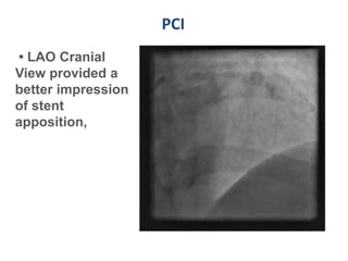 PCI
• LAO Cranial
View provided a
better impression
of stent
apposition,
 