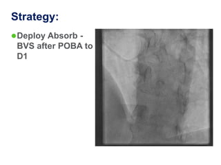 Strategy:
 Deploy Absorb -
 BVS after POBA to
 D1
 