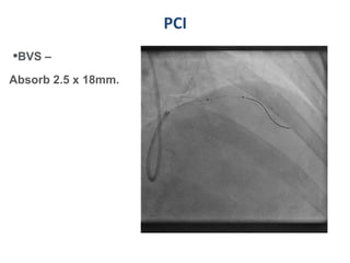 PCI
•BVS –
Absorb 2.5 x 18mm.
 