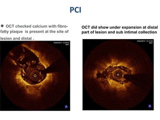 PCI
● OCT checked calcium with fibro-              OCT did show under expansion at distal
fatty plaque is present at the site of         part of lesion and sub intimal collection
lesion and distal .
 