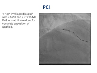 PCI
● High Pressure dilatation
with 2.5x10 and 2.75x15 NC
Balloons at 12 atm done for
complete apposition of
Scaffold.
 