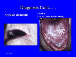Diagnosis Cont…..
Angular stomatitis
Glositis
( Vit B12, Iron, Folate, Niacin)
03/12/25 27
 
