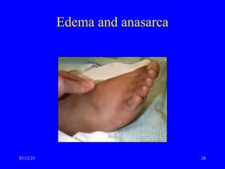 Edema and anasarca
03/12/25 28
 