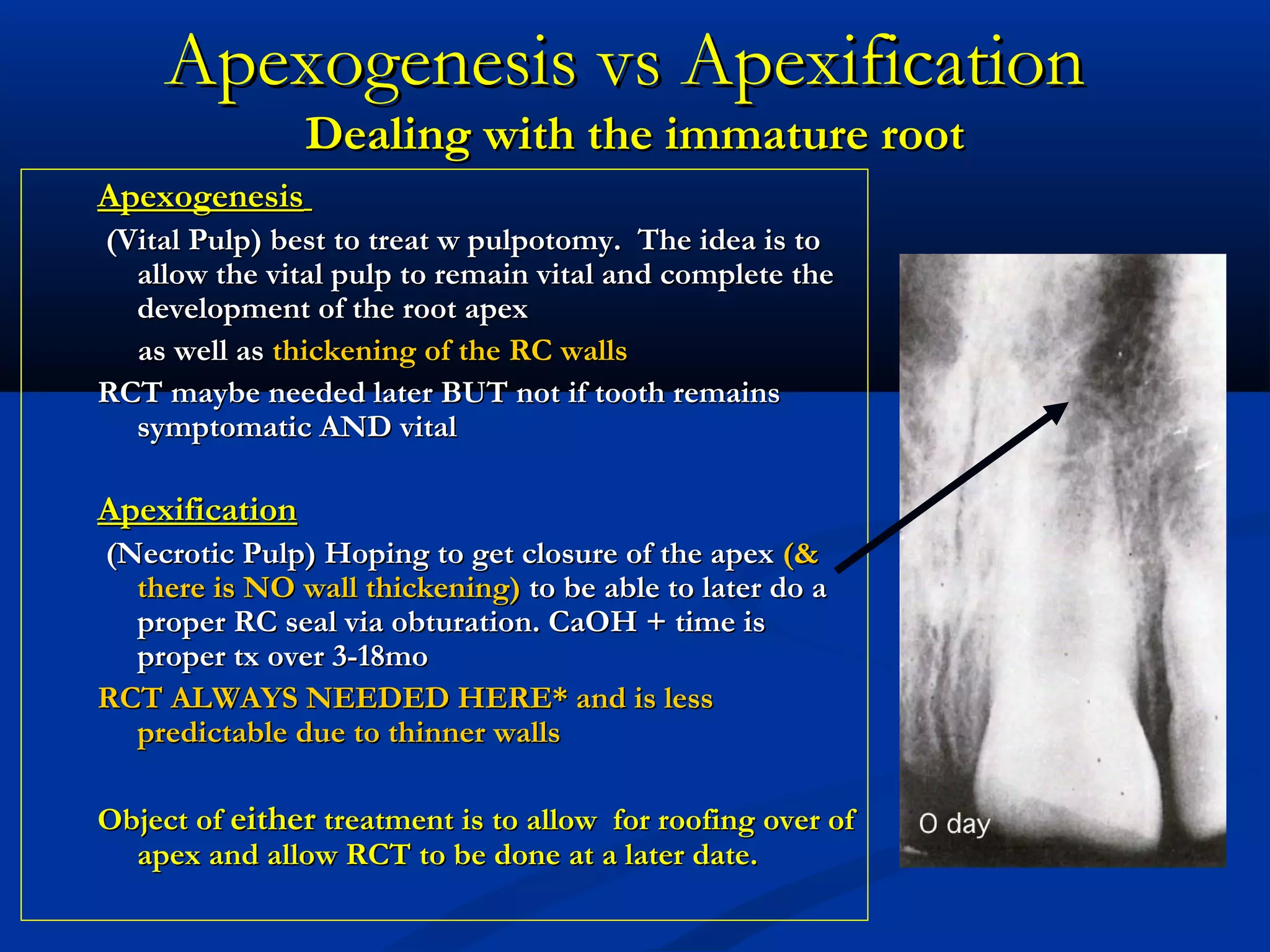 Apexogenesis vs Apexification
Dealing with the immature root

Apexogenesis
(Vital Pulp) best to treat w pulpotomy. The idea is to
allow the vital pulp to remain vital and complete the
development of the root apex
as well as thickening of the RC walls
RCT maybe needed later BUT not if tooth remains
symptomatic AND vital

Apexification
(Necrotic Pulp) Hoping to get closure of the apex (&
there is NO wall thickening) to be able to later do a
proper RC seal via obturation. CaOH + time is
proper tx over 3-18mo
RCT ALWAYS NEEDED HERE* and is less
predictable due to thinner walls
Object of either treatment is to allow for roofing over of
apex and allow RCT to be done at a later date.

 