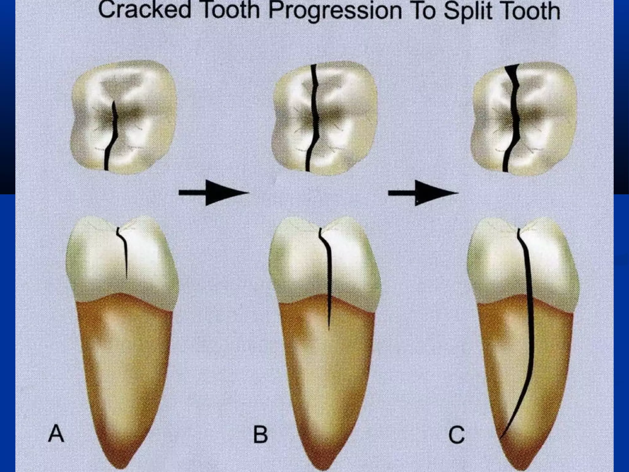 Insert occlusal view of MMR/DMR
fracture to supplement previous slide


Because, endo/perio lesion can mimic VRF
radiogragraph

 
