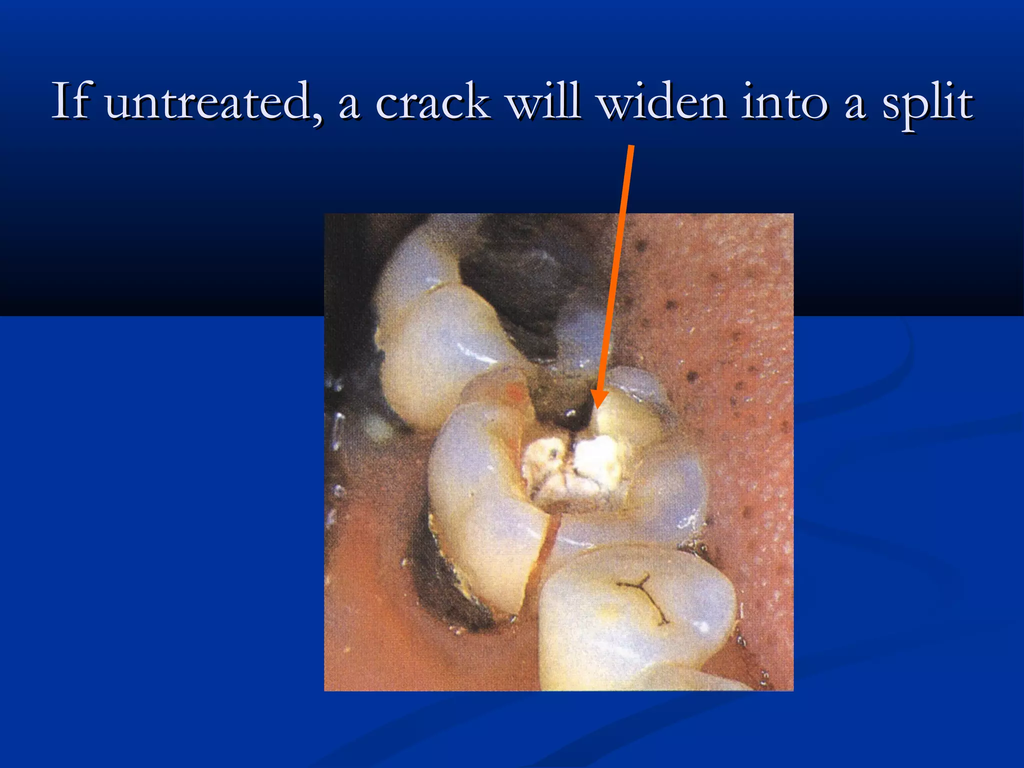 If untreated, a crack will widen into a split

 