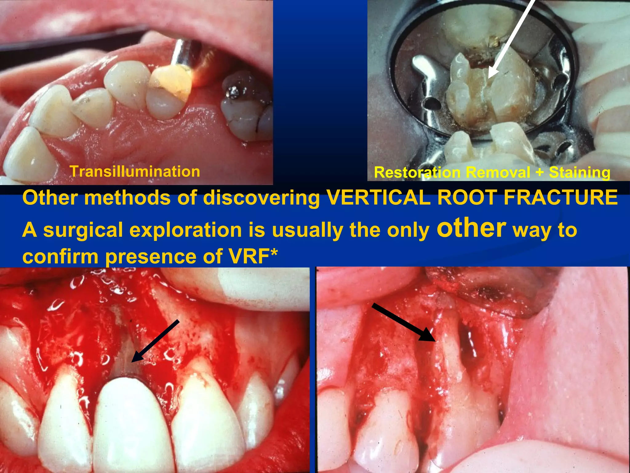 Transillumination

Restoration Removal + Staining

Other methods of discovering VERTICAL ROOT FRACTURE
A surgical exploration is usually the only other way to
confirm presence of VRF*

 