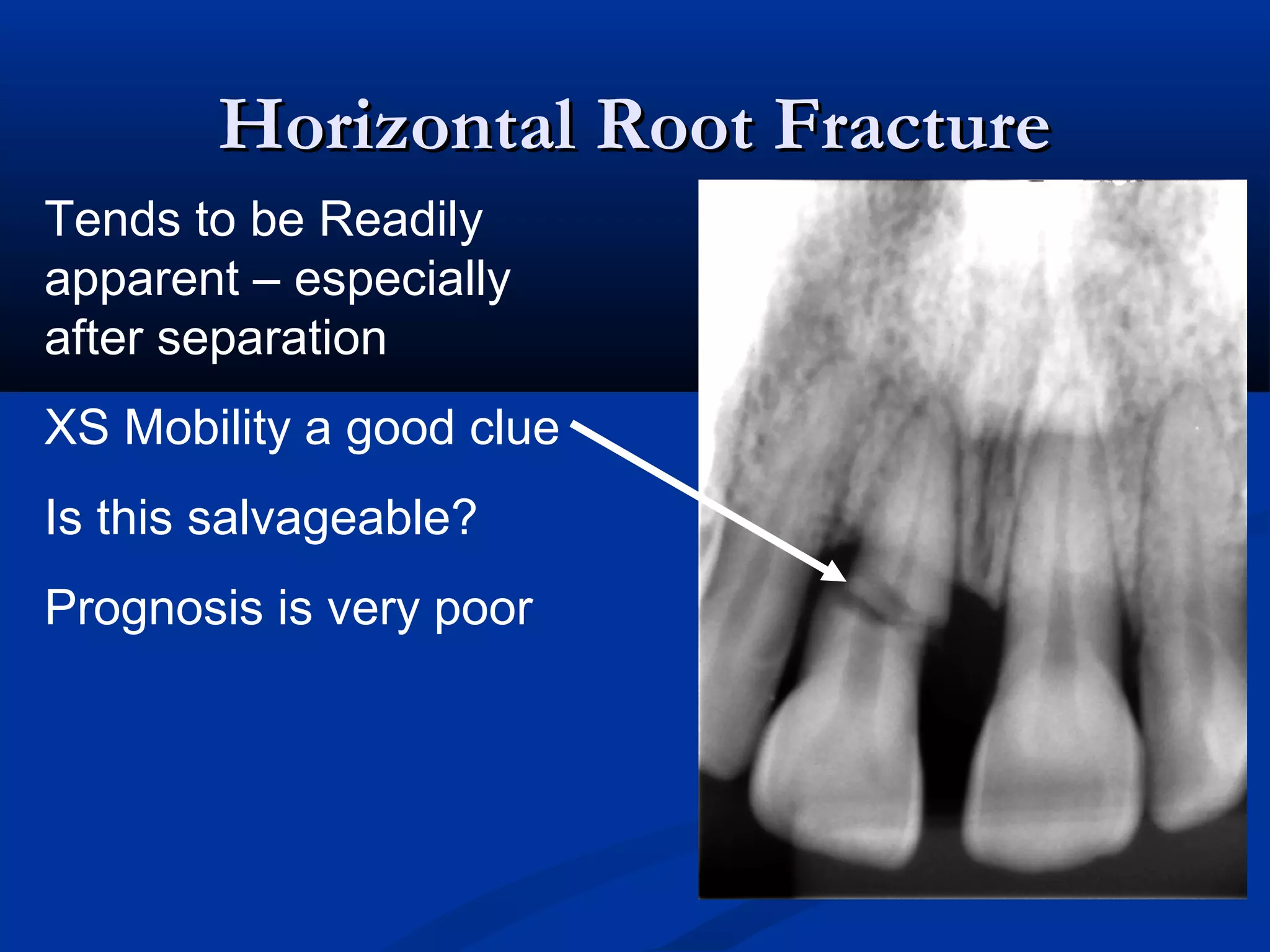Horizontal Root Fracture
Tends to be Readily
apparent – especially
after separation
XS Mobility a good clue
Is this salvageable?
Prognosis is very poor

 
