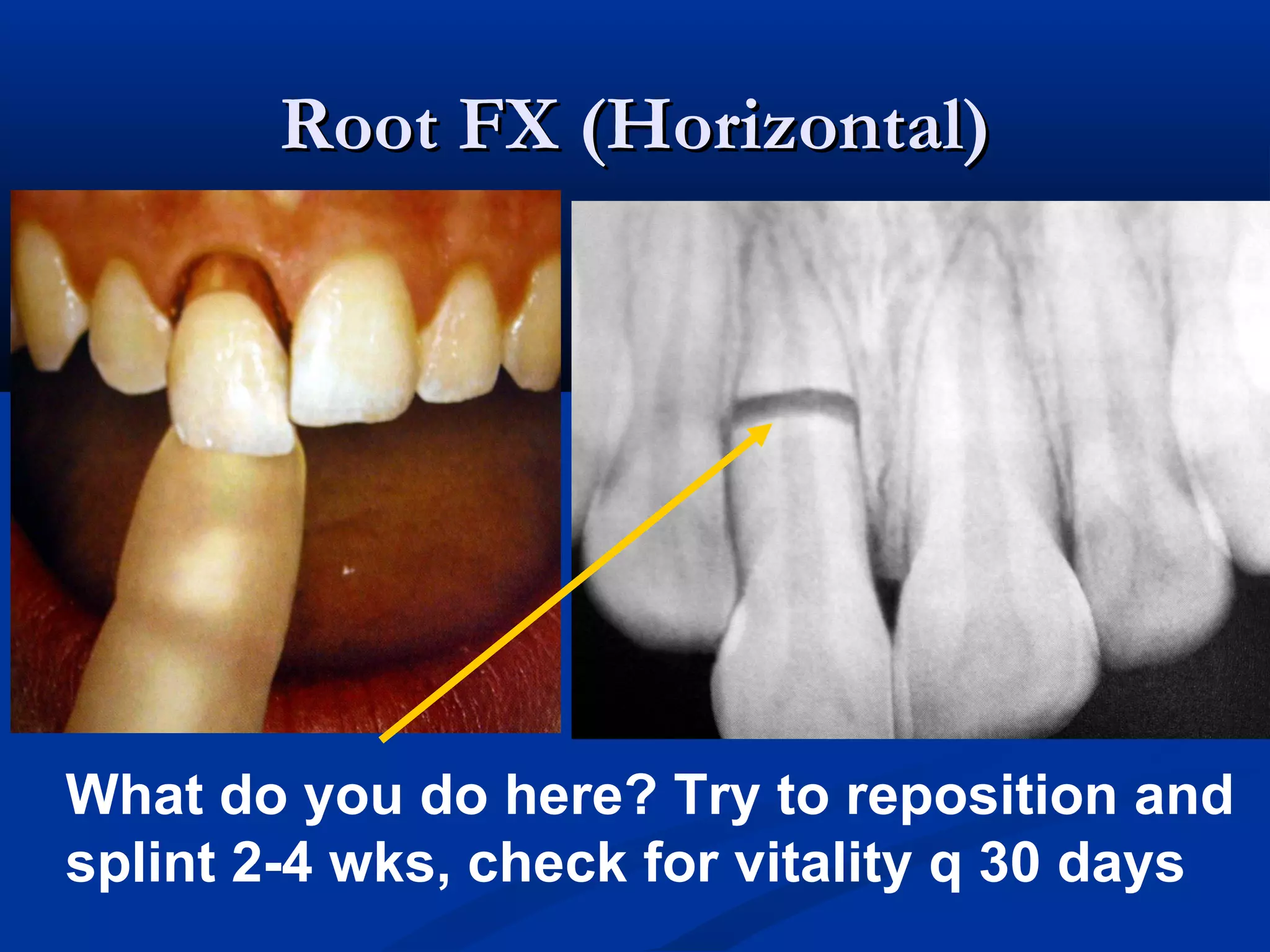 Root FX (Horizontal)

What do you do here? Try to reposition and
splint 2-4 wks, check for vitality q 30 days

 