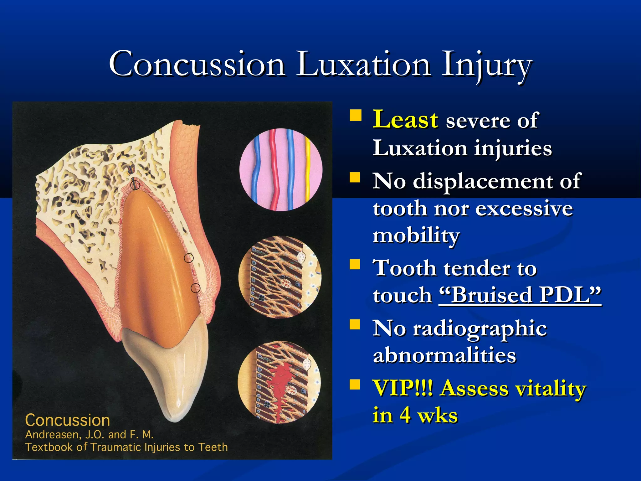 Concussion Luxation Injury







Least severe of

Luxation injuries
No displacement of
tooth nor excessive
mobility
Tooth tender to
touch “Bruised PDL”
No radiographic
abnormalities
VIP!!! Assess vitality
in 4 wks

 