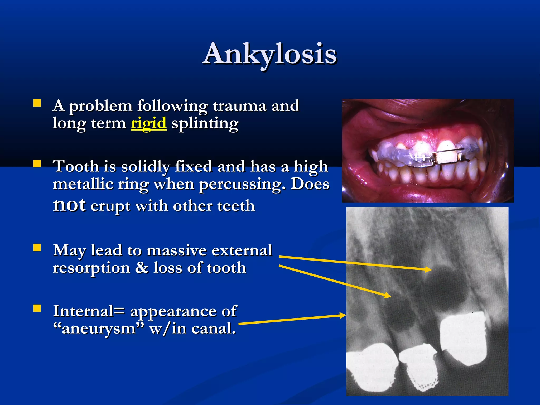 Ankylosis


A problem following trauma and
long term rigid splinting



Tooth is solidly fixed and has a high
metallic ring when percussing. Does
not erupt with other teeth



May lead to massive external
resorption & loss of tooth



Internal= appearance of
“aneurysm” w/in canal.

 