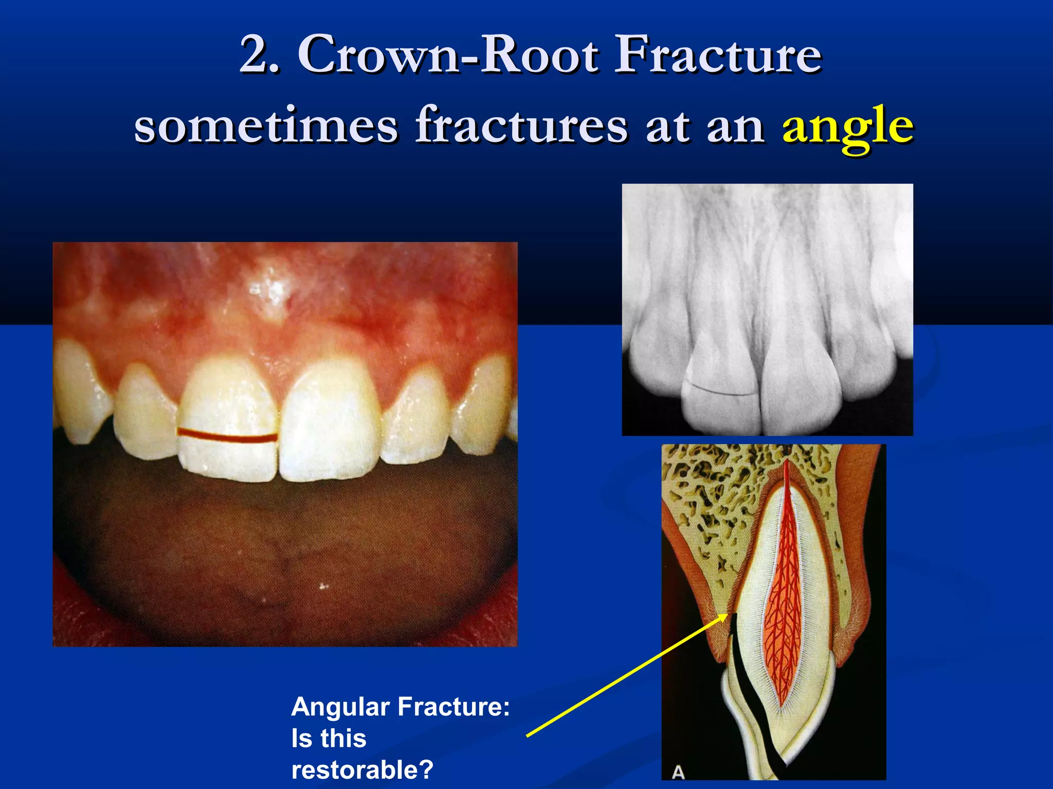 2. Crown-Root Fracture
sometimes fractures at an angle

Angular Fracture:
Is this
restorable?

 