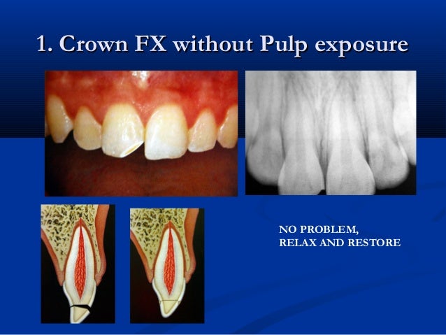 Dental Trauma - 