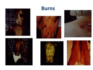 The judge said a metal pole was used to shatter Sanam's leg