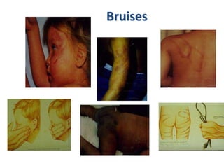 Both of Sanam's thigh bones had been fractured, causing fatty deposits to enter her bloodstream and resulting in her death, and she had fractures to both her arms.