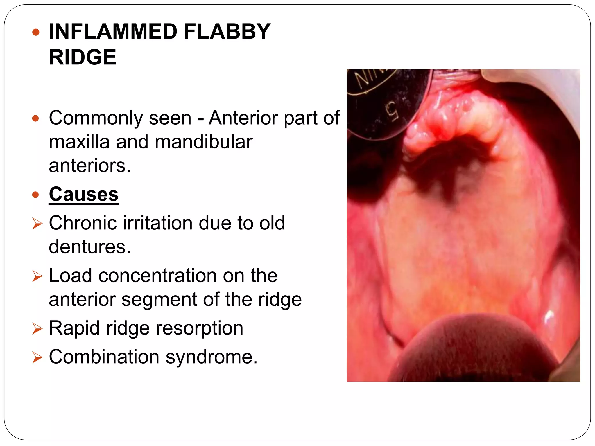 Flabby Ridge Radiograph Abused tissue management | PPTX
