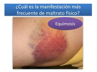 ¿Cuál es la manifestación más frecuente de maltrato físico? 
Equimosis  