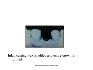 Inlay casting wax is added and entire crown is
formed.
www.indiandentalacademy.com
 