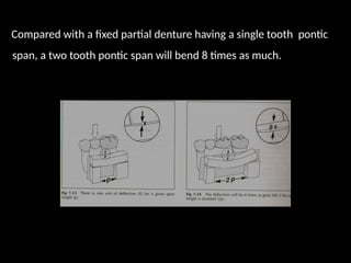 Compared with a fixed partial denture having a single tooth pontic
span, a two tooth pontic span will bend 8 times as much.
 