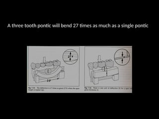 A three tooth pontic will bend 27 times as much as a single pontic
 