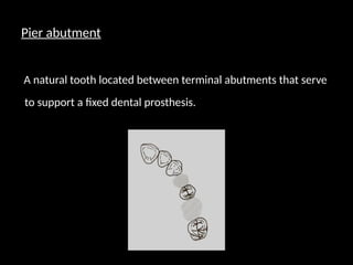 Pier abutment
A natural tooth located between terminal abutments that serve
to support a fixed dental prosthesis.
 