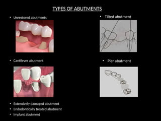 TYPES OF ABUTMENTS
• Unrestored abutments
• Cantilever abutment
• Extensively damaged abutment
• Endodontically treated abutment
• Implant abutment
• Tilted abutment
• Pier abutment
 