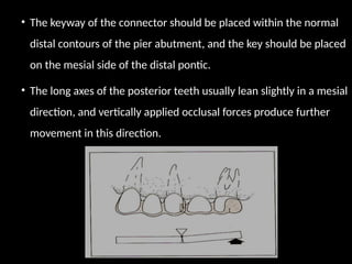 • The keyway of the connector should be placed within the normal
distal contours of the pier abutment, and the key should be placed
on the mesial side of the distal pontic.
• The long axes of the posterior teeth usually lean slightly in a mesial
direction, and vertically applied occlusal forces produce further
movement in this direction.
 