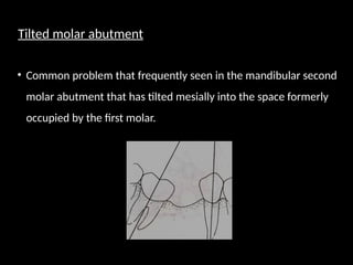 Tilted molar abutment
• Common problem that frequently seen in the mandibular second
molar abutment that has tilted mesially into the space formerly
occupied by the first molar.
 