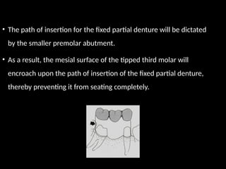 • The path of insertion for the fixed partial denture will be dictated
by the smaller premolar abutment.
• As a result, the mesial surface of the tipped third molar will
encroach upon the path of insertion of the fixed partial denture,
thereby preventing it from seating completely.
 