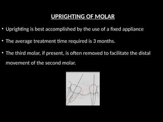 UPRIGHTING OF MOLAR
• Uprighting is best accomplished by the use of a fixed appliance
• The average treatment time required is 3 months.
• The third molar, if present, is often removed to facilitate the distal
movement of the second molar.
 