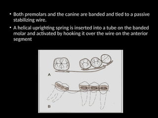 • Both premolars and the canine are banded and tied to a passive
stabilizing wire.
• A helical uprighting spring is inserted into a tube on the banded
molar and activated by hooking it over the wire on the anterior
segment
 