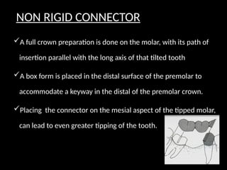 A full crown preparation is done on the molar, with its path of
insertion parallel with the long axis of that tilted tooth
A box form is placed in the distal surface of the premolar to
accommodate a keyway in the distal of the premolar crown.
Placing the connector on the mesial aspect of the tipped molar,
can lead to even greater tipping of the tooth.
NON RIGID CONNECTOR
 