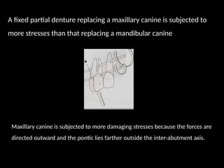 A fixed partial denture replacing a maxillary canine is subjected to
more stresses than that replacing a mandibular canine
Maxillary canine is subjected to more damaging stresses because the forces are
directed outward and the pontic lies farther outside the inter-abutment axis.
 