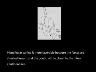 Mandibular canine is more favorable because the forces are
directed inward and the pontic will be closer to the inter-
abutment axis.
 