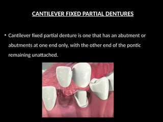 CANTILEVER FIXED PARTIAL DENTURES
• Cantilever fixed partial denture is one that has an abut­
ment or
abutments at one end only, with the other end of the pontic
remaining unattached.
 