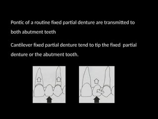 Pontic of a routine fixed partial denture are transmitted to
both abutment teeth
Cantilever fixed partial denture tend to tip the fixed partial
denture or the abutment tooth.
 