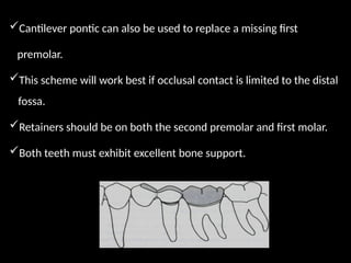 Cantilever pontic can also be used to replace a missing first
premolar.
This scheme will work best if occlusal contact is limited to the distal
fossa.
Retainers should be on both the second premolar and first molar.
Both teeth must exhibit excellent bone support.
 