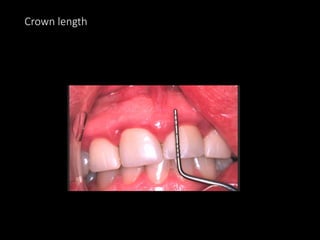 Crown length
 